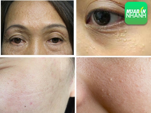 Mụn thịt là gì? Nguyên nhân gây mụn