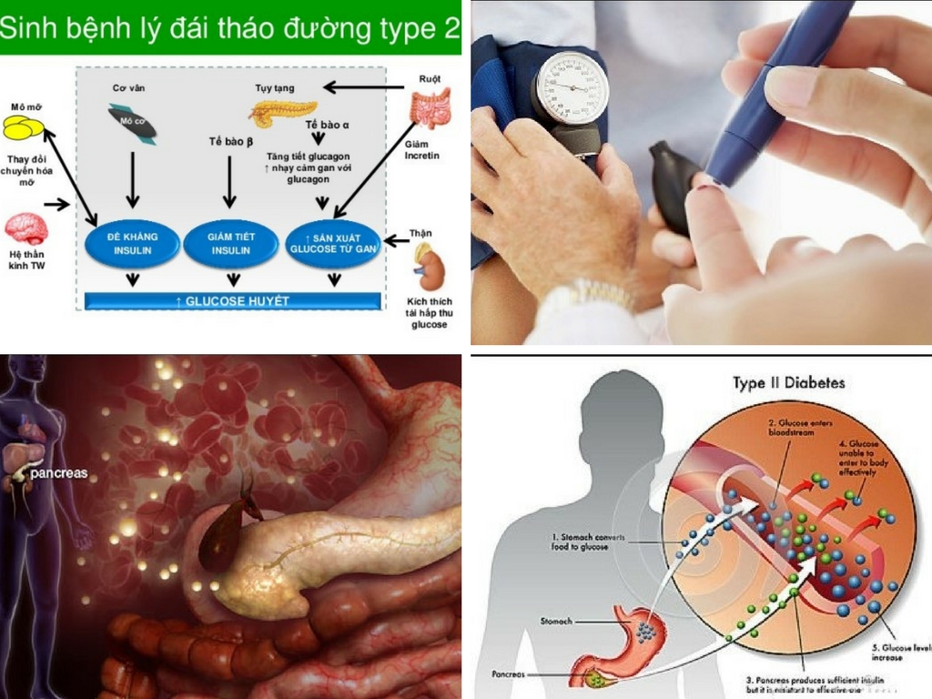 Tiểu đường tuýp 2 (type 2) là nặng hay nhẹ